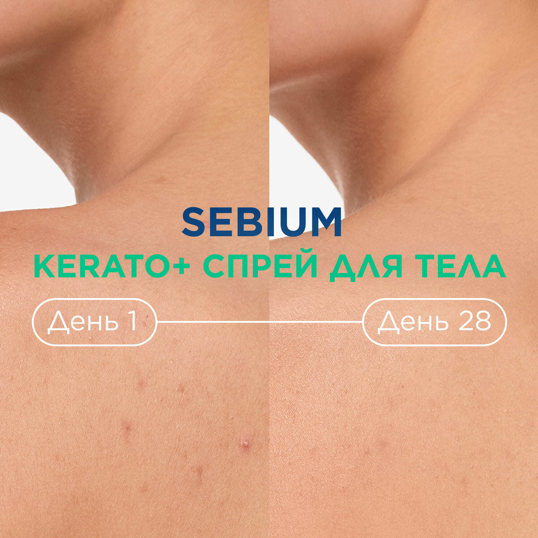 Sébium Kerato+ Cпрей для тела против несовершенств BIODERMA Сокращение несовершенств на теле через 7 дней* миниатюра 5