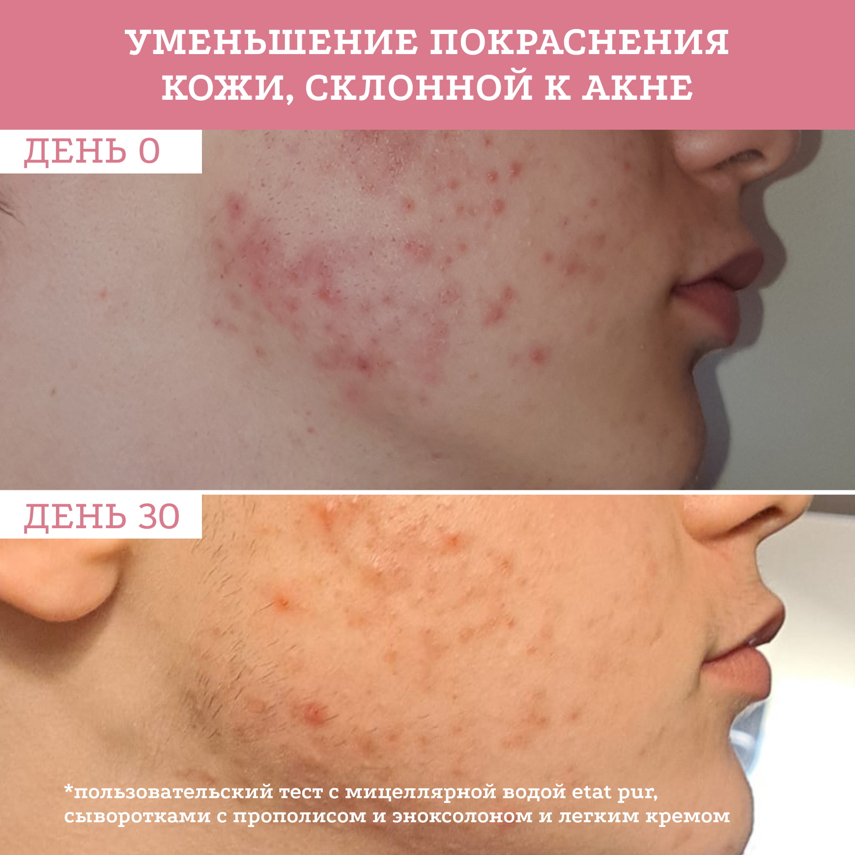 Активные молекулы Сыворотка с эноксолоном 2% Etat Pur Уменьшение ощущения стянутости и чувства дискомфорта миниатюра 5